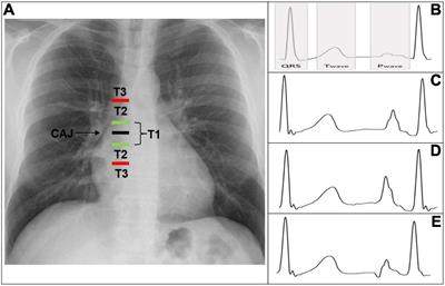 ECG-Based Techniques to Optimize Peripherally Inserted Central Catheters: Rationale for Tip Positioning and Practical Use